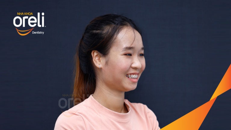 Niềng răng hô nhổ 4 răng số 4 – Bao lâu thì đẹp? Case thực tế