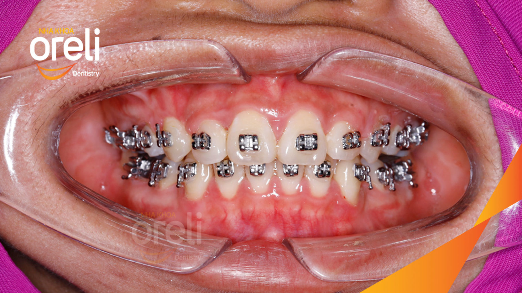  trước khi điều trị tại Oreli