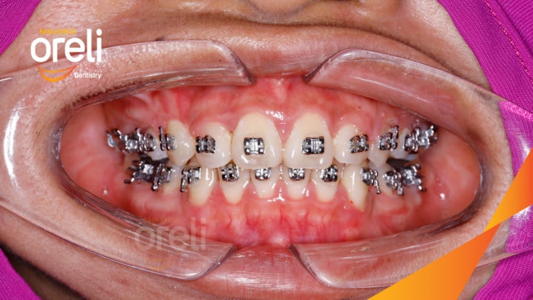 Niềng răng hô nhổ 4 răng số 4 – Bao lâu thì đẹp? Case thực tế