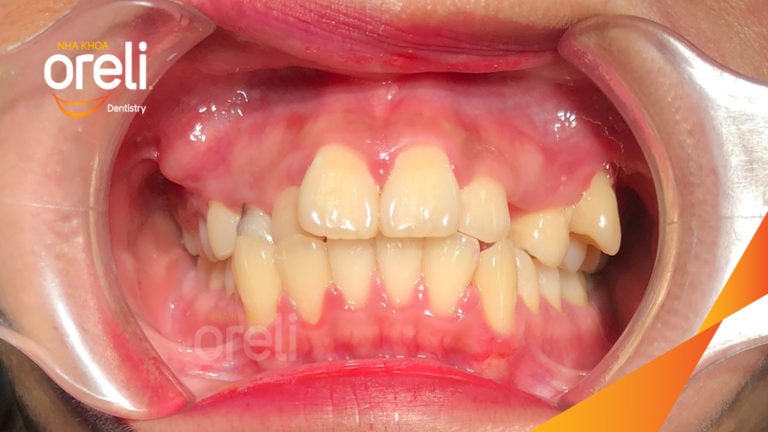 Niềng răng hô nhổ 4 răng số 4 – Bao lâu thì đẹp? Case thực tế