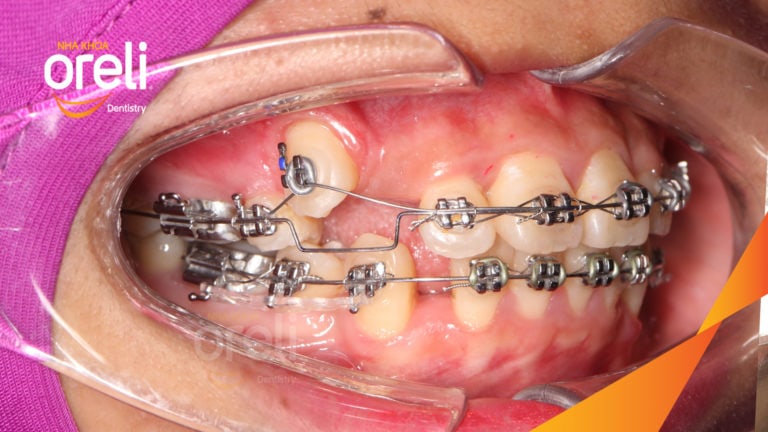 Niềng răng hô nhổ 4 răng số 4 – Bao lâu thì đẹp? Case thực tế