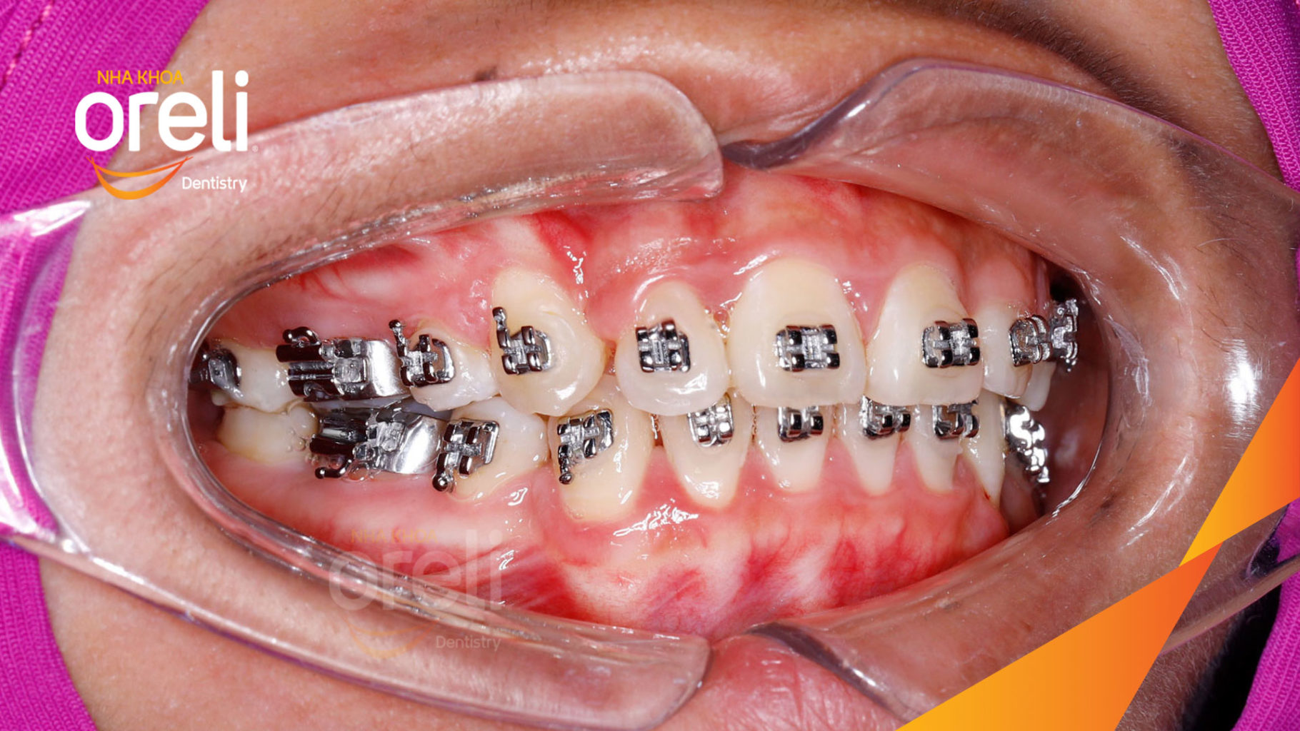 Thực hiện  kéo dài  tại Oreli