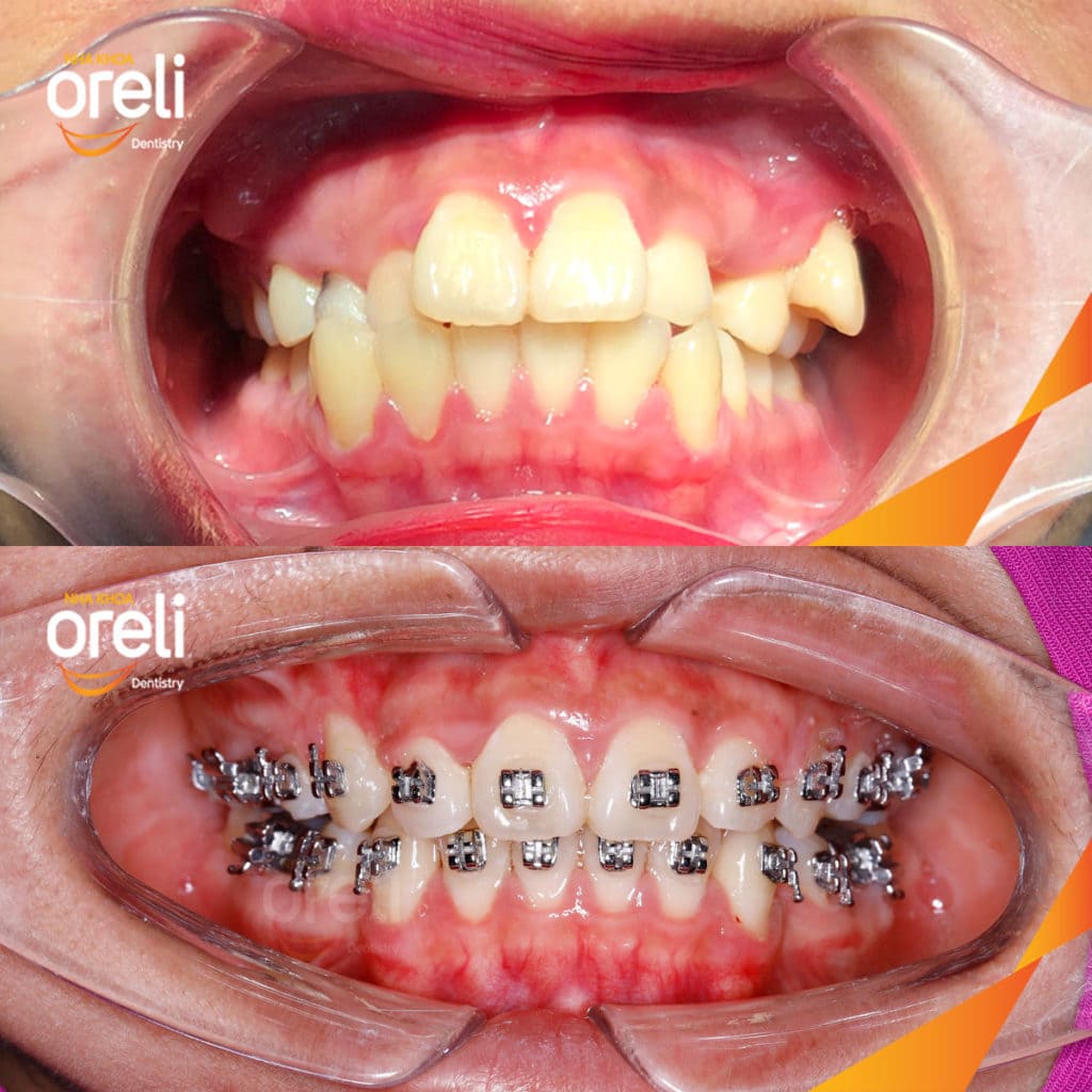 Niềng răng hô nhổ 4 răng số 4 – Bao lâu thì đẹp? Case thực tế