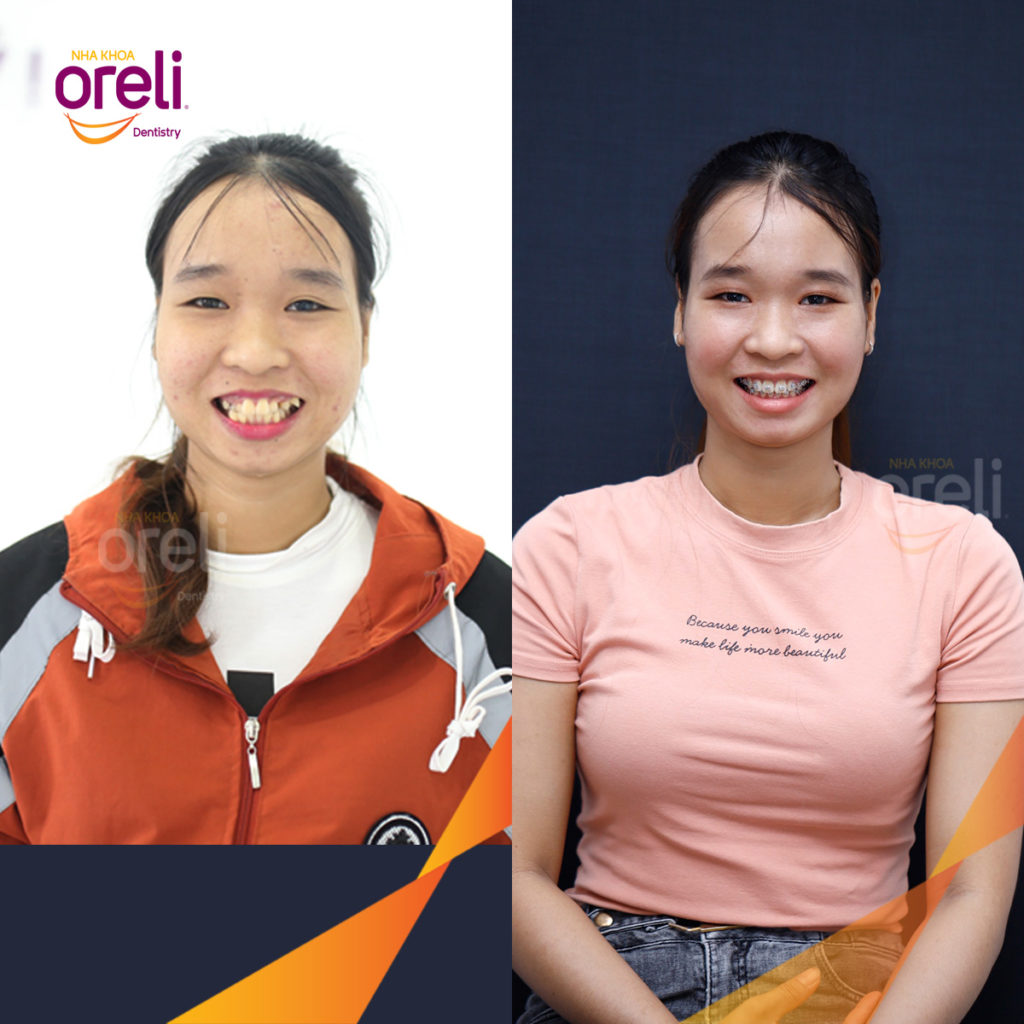 Kết quả đạt được sau  -  tại Oreli