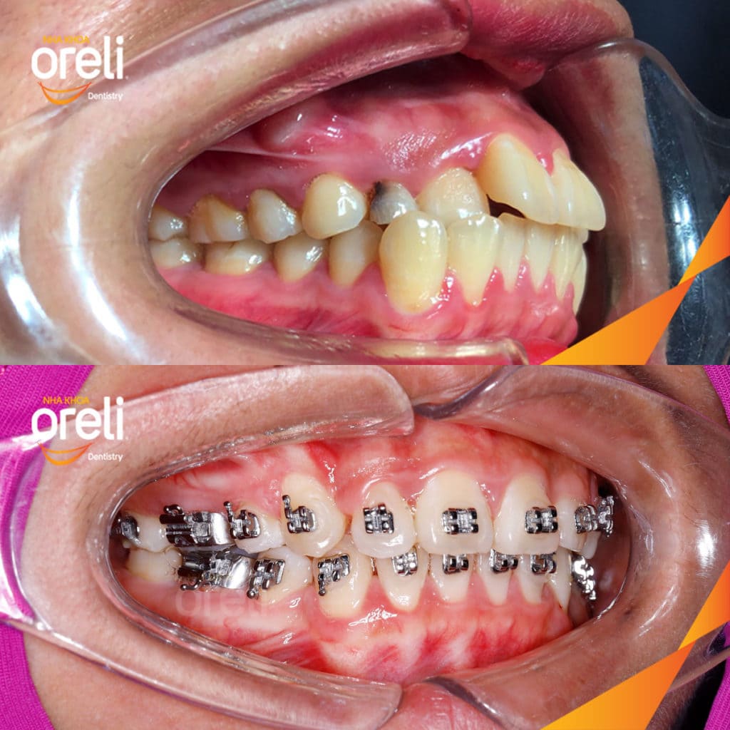 Niềng răng hô nhổ 4 răng số 4 – Bao lâu thì đẹp? Case thực tế