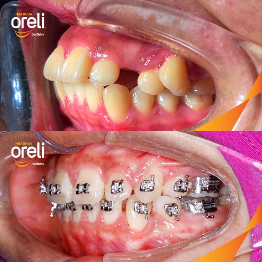 Niềng răng hô nhổ 4 răng số 4 – Bao lâu thì đẹp? Case thực tế