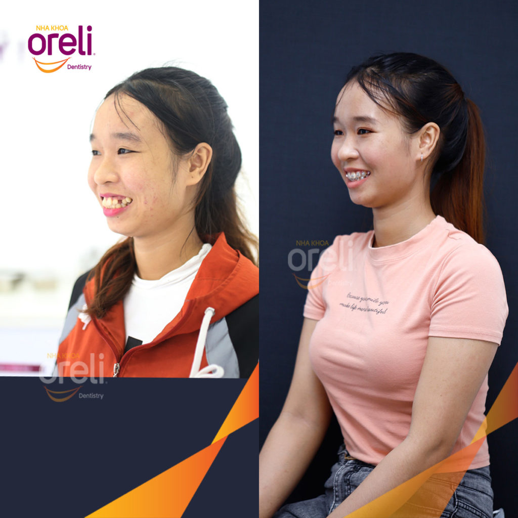 Thực hiện  kéo dài  tại Oreli