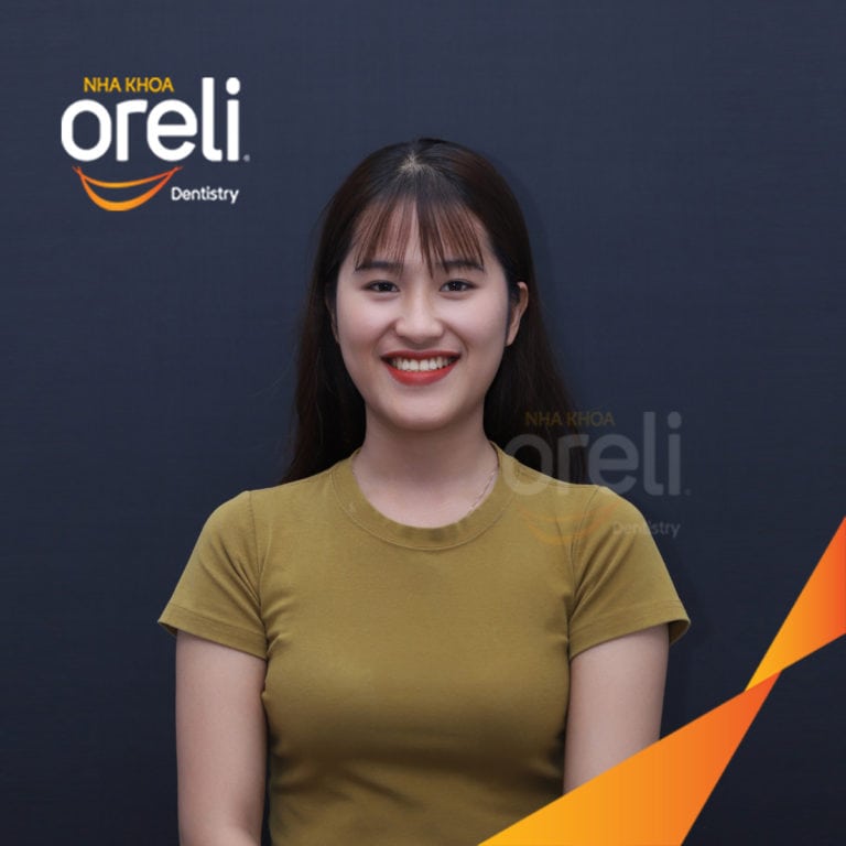 Ca niềng chỉnh móm chen chúc nặng hai hàm kết quả thay đổi nụ cười khuôn mặt tại Oreli