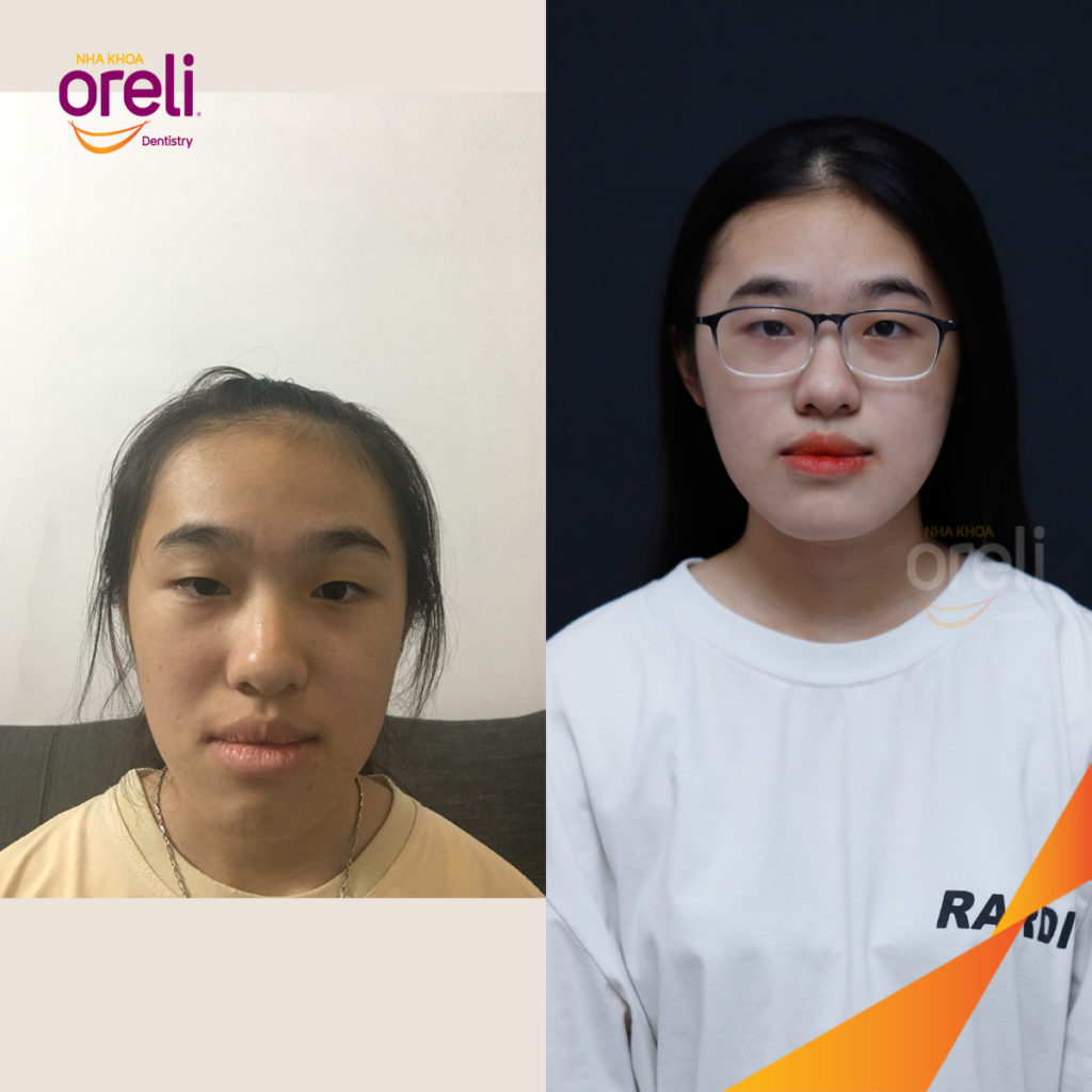 Quá trình  trong  tại Oreli