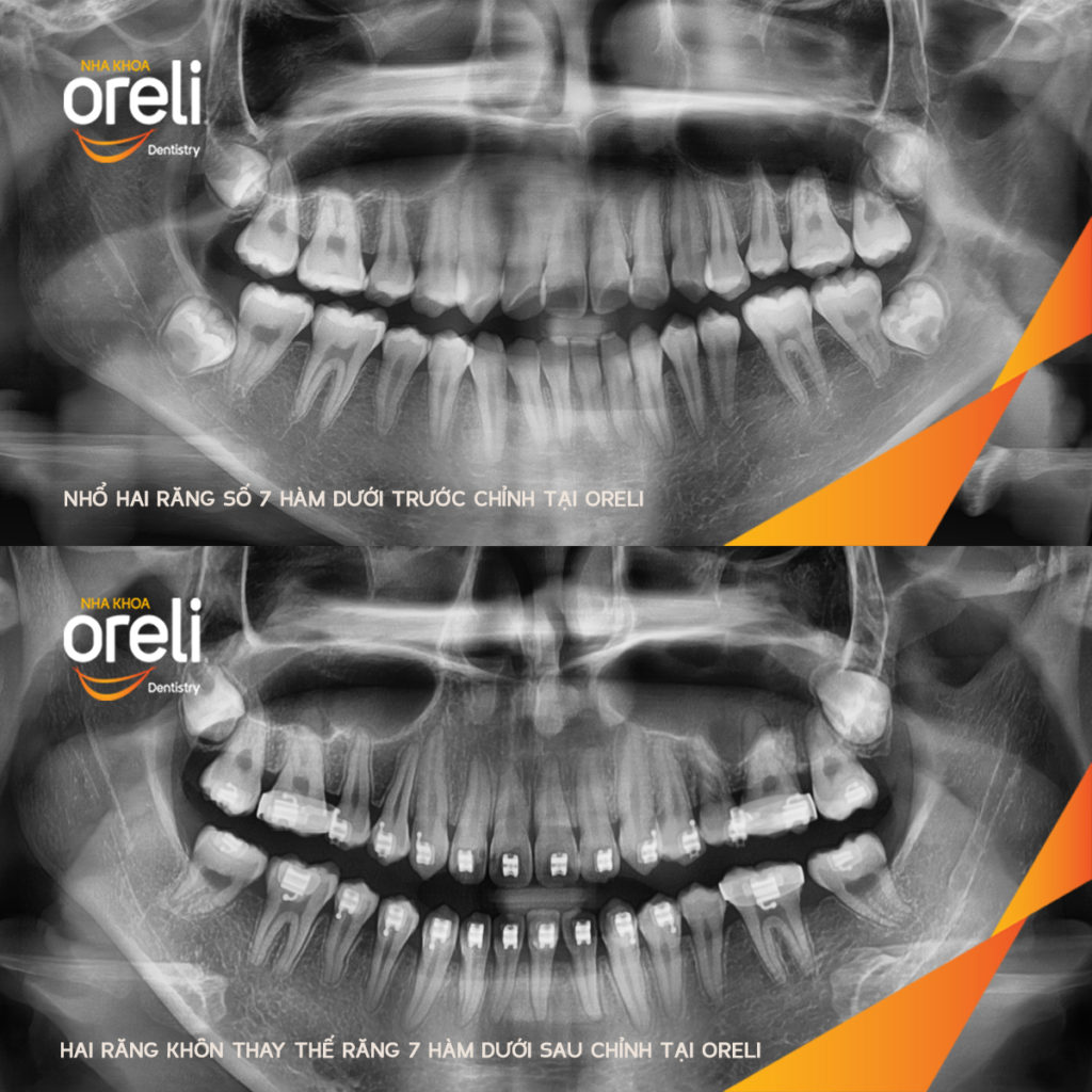  trước khi điều trị tại Oreli