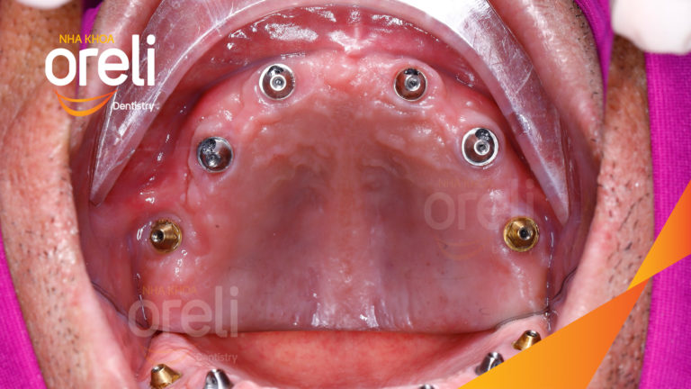 cay ghep implant toan ham uy tin buon ma thuot nha khoa oreli