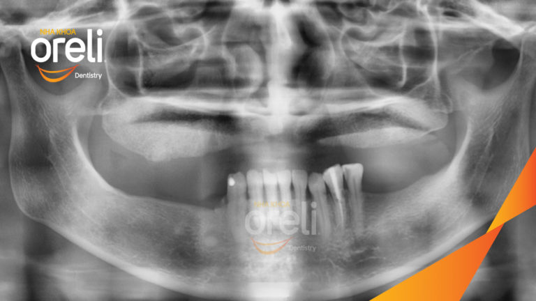 Mất răng hàm trên? Implant giúp phục hồi toàn diện chức năng và thẩm mỹ | Oreli