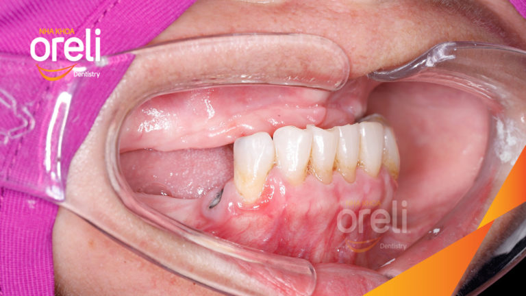 Mất răng hàm trên? Implant giúp phục hồi toàn diện chức năng và thẩm mỹ | Oreli