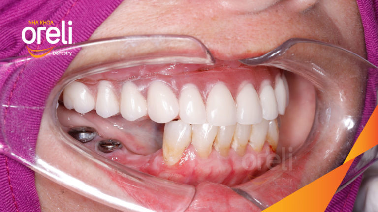 Mất răng hàm trên? Implant giúp phục hồi toàn diện chức năng và thẩm mỹ | Oreli