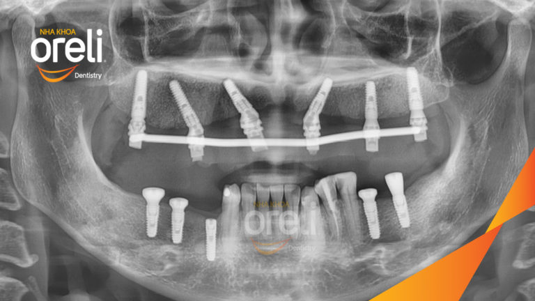 Mất răng hàm trên? Implant giúp phục hồi toàn diện chức năng và thẩm mỹ | Oreli