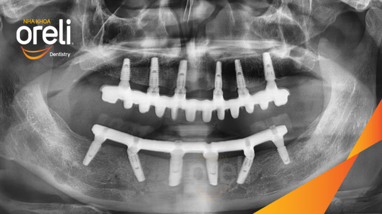 Ca trồng răng hai hàm thay đổi nụ cười và ăn nhai chắc chắn – Kết quả thực tế | Oreli