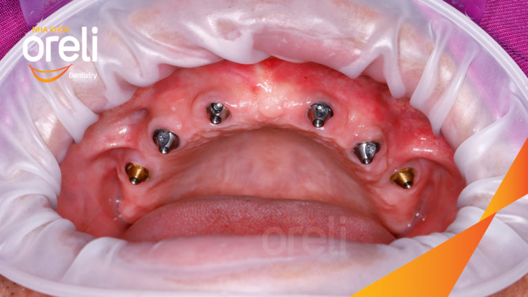 Ca trồng răng hai hàm thay đổi nụ cười và ăn nhai chắc chắn – Kết quả thực tế | Oreli