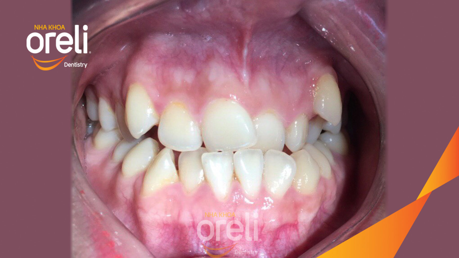 Trước điều trị:  tại Oreli