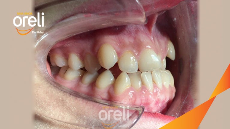 Niềng răng móm hạng 3 – Trước & sau tại Buôn Ma Thuột