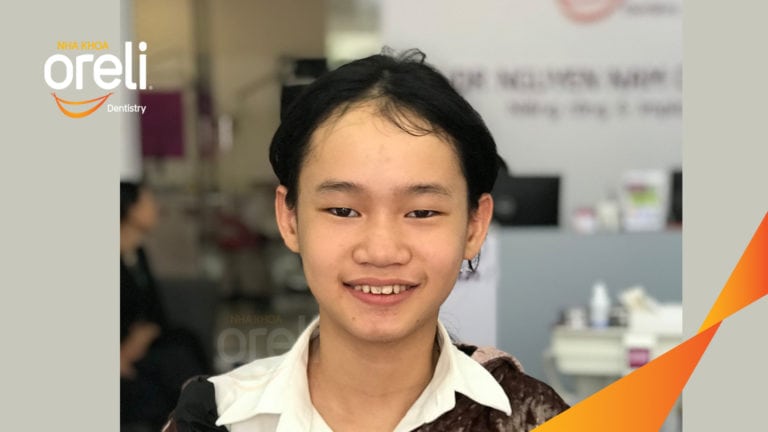 Ca niềng chỉnh cắn sâu hô nặng – Kết quả thực tế tại nha khoa Oreli