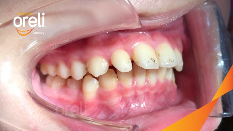 Ca niềng chỉnh cắn sâu hô nặng – Kết quả thực tế tại nha khoa Oreli