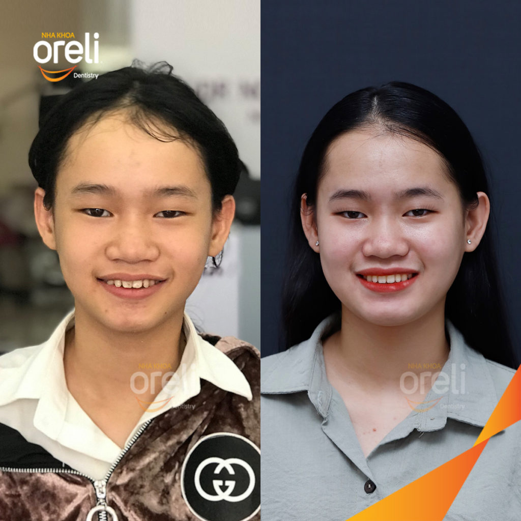  trước khi điều trị tại Oreli