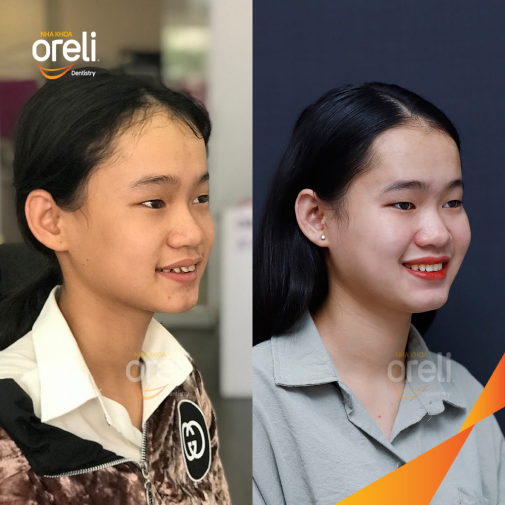 Trước điều trị:  tại Oreli