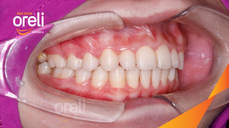 Ca niềng chỉnh cắn sâu hô nặng – Kết quả thực tế tại nha khoa Oreli