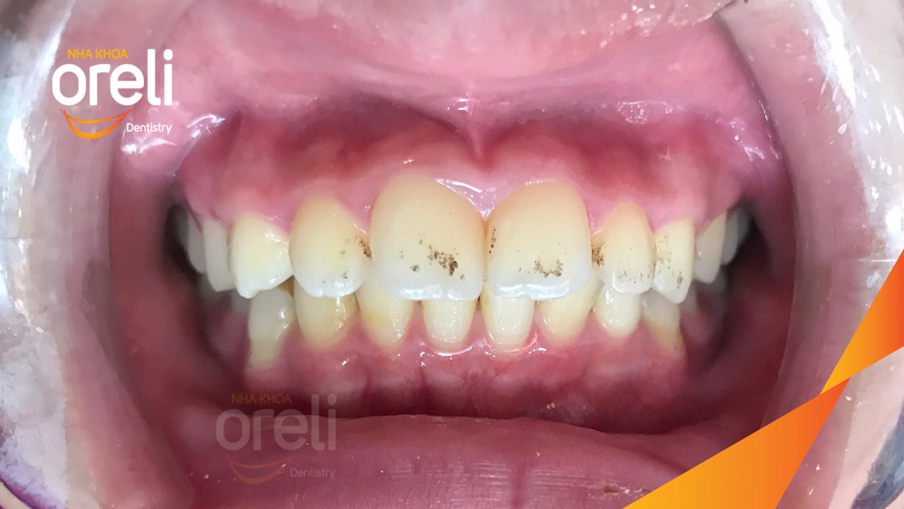 Kết quả sau :  tại Oreli