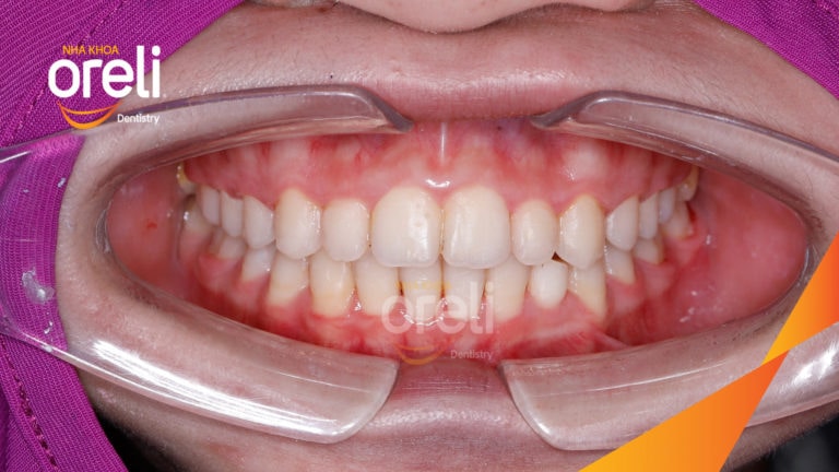 Ca niềng chỉnh cắn sâu hô nặng – Kết quả thực tế tại nha khoa Oreli