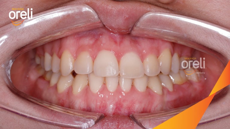 Niềng răng móm hạng 3 – Trước & sau tại Buôn Ma Thuột
