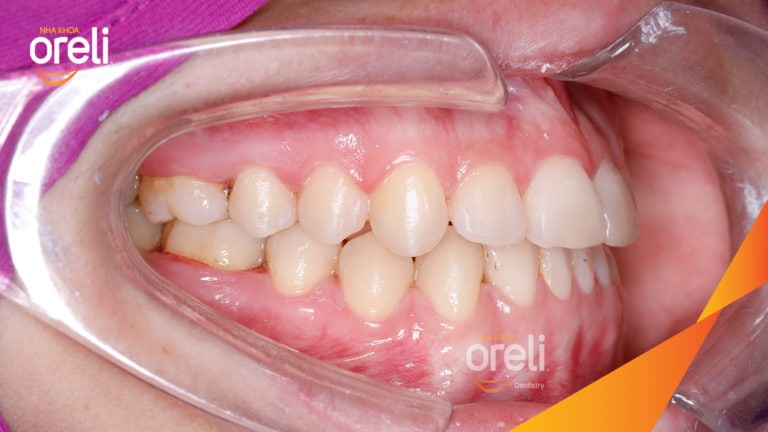 Niềng răng móm hạng 3 – Trước & sau tại Buôn Ma Thuột