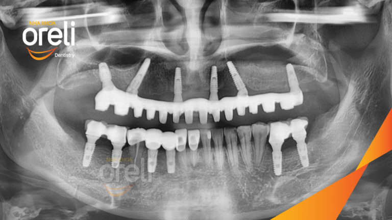 Ca cấy ghép Implant toàn hàm trên và 6 răng implant đơn lẻ hàm dưới tại Oreli