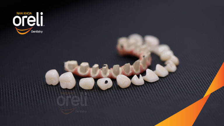 Ca cấy ghép Implant toàn hàm trên và 6 răng implant đơn lẻ hàm dưới tại Oreli