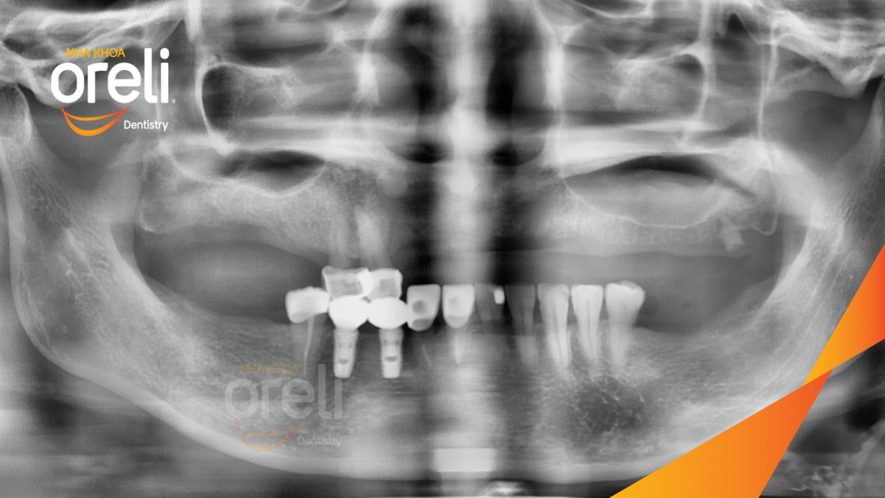 Trước điều trị:  tại Oreli
