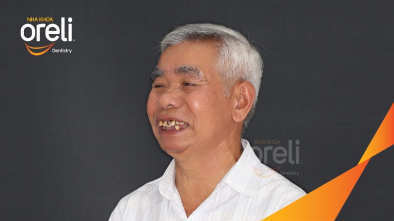 Trồng răng hai hàm kèm chỉnh hô xương – Kết quả thực tế | Oreli