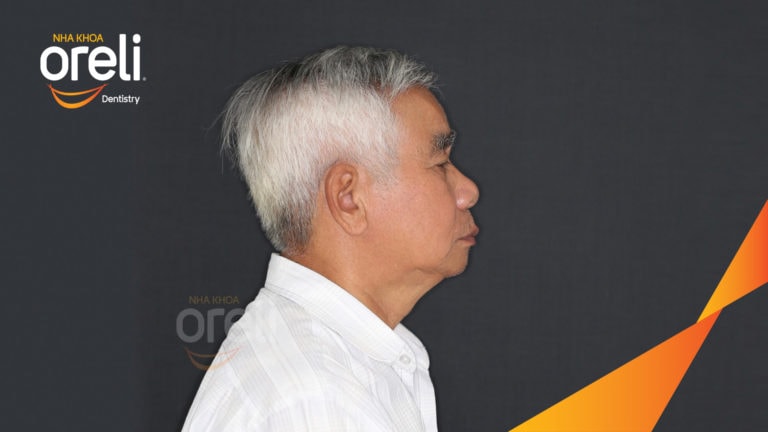 Trồng răng hai hàm kèm chỉnh hô xương – Kết quả thực tế | Oreli