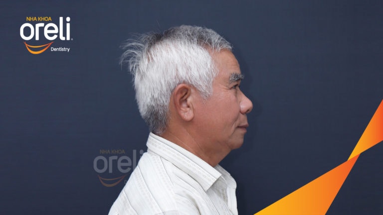 Trồng răng hai hàm kèm chỉnh hô xương – Kết quả thực tế | Oreli