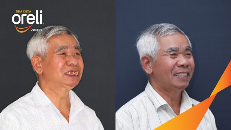 cay ghep implant chinh ho oreli bmt