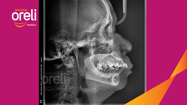 Trồng răng hai hàm kèm chỉnh hô xương – Kết quả thực tế | Oreli