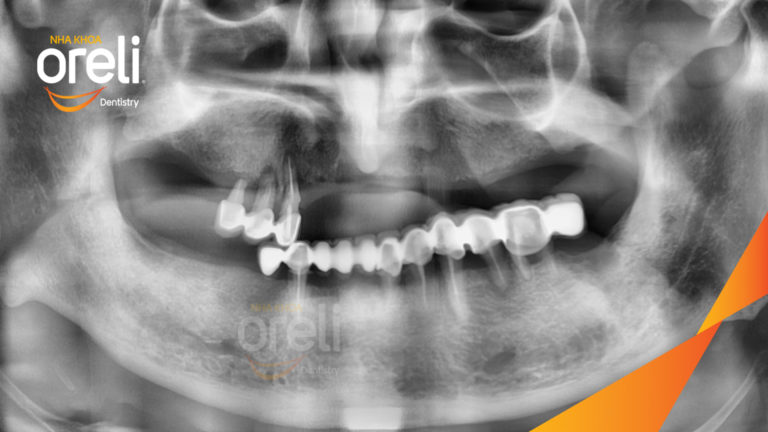 Ca trồng răng hàm trên kỹ thuật không lật vạt – Phục hồi nhanh ít đau | Oreli