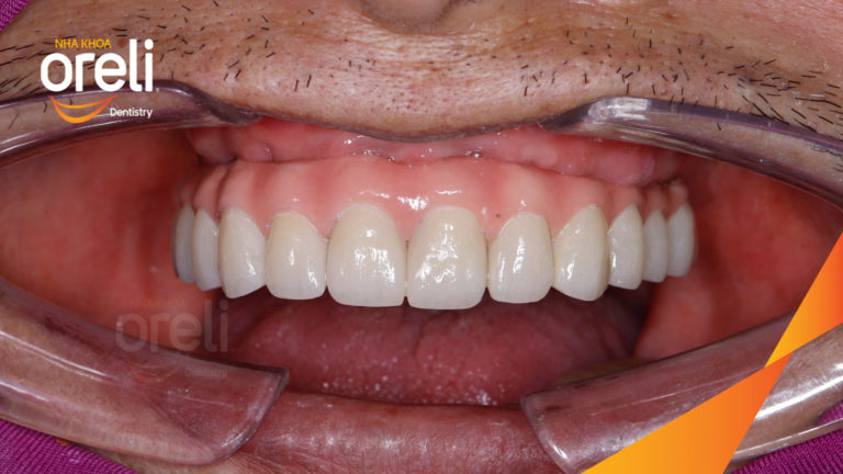 Ca trồng răng hàm trên kỹ thuật không lật vạt – Phục hồi nhanh ít đau | Oreli