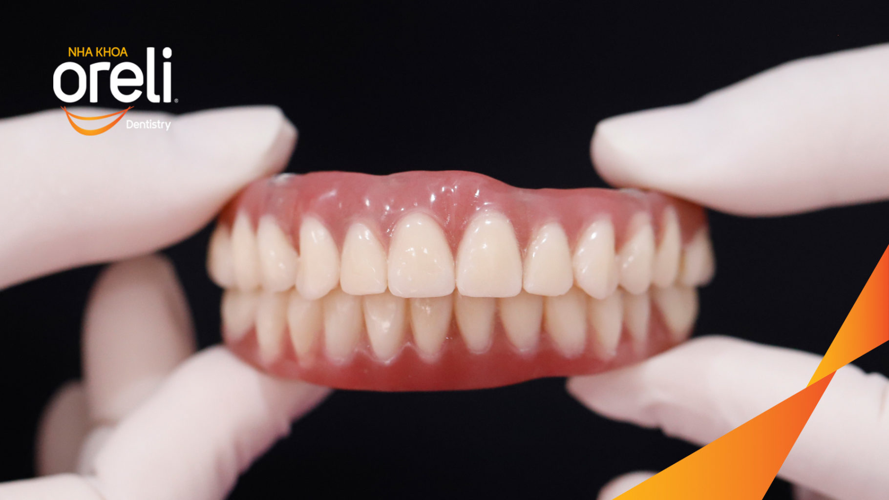 cay implant toan ham chinh ho tai Oreli