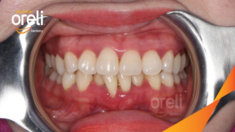 Ca niềng mắc cài tự khóa không nhổ răng – Kết quả sau 24 tháng tại nha khoa Oreli