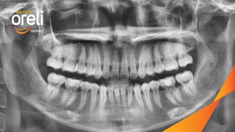 Ca niềng mắc cài tự khóa không nhổ răng – Kết quả sau 24 tháng tại nha khoa Oreli