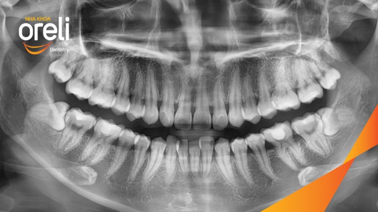 Ca niềng mắc cài tự khóa không nhổ răng – Kết quả sau 24 tháng tại nha khoa Oreli