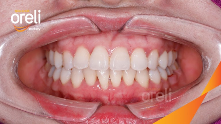 Ca niềng mắc cài tự khóa không nhổ răng – Kết quả sau 24 tháng tại nha khoa Oreli
