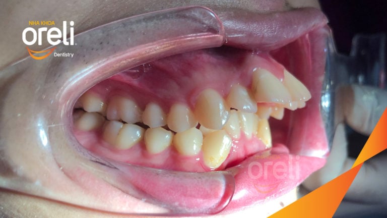 Ca niềng chỉnh hô nặng thay đổi nụ cười hoàn toàn kết quả sau 3 năm ở Oreli
