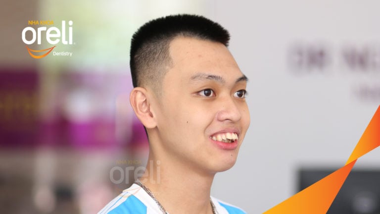Ca niềng chỉnh hô nặng thay đổi nụ cười hoàn toàn kết quả sau 3 năm ở Oreli
