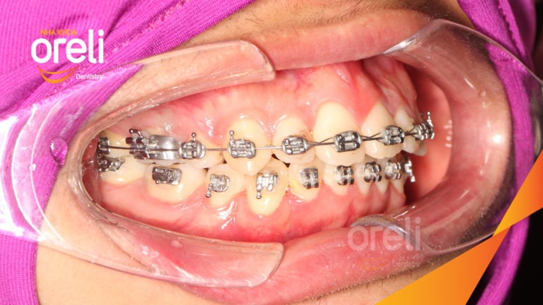 Ca niềng chỉnh hô nặng thay đổi nụ cười hoàn toàn kết quả sau 3 năm ở Oreli